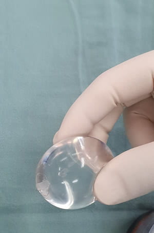 GC yüksek kohezif silikon jel testis protezi steril eldivenle tutulurken; yarı saydam, pürüzsüz yüzeyli oval implant