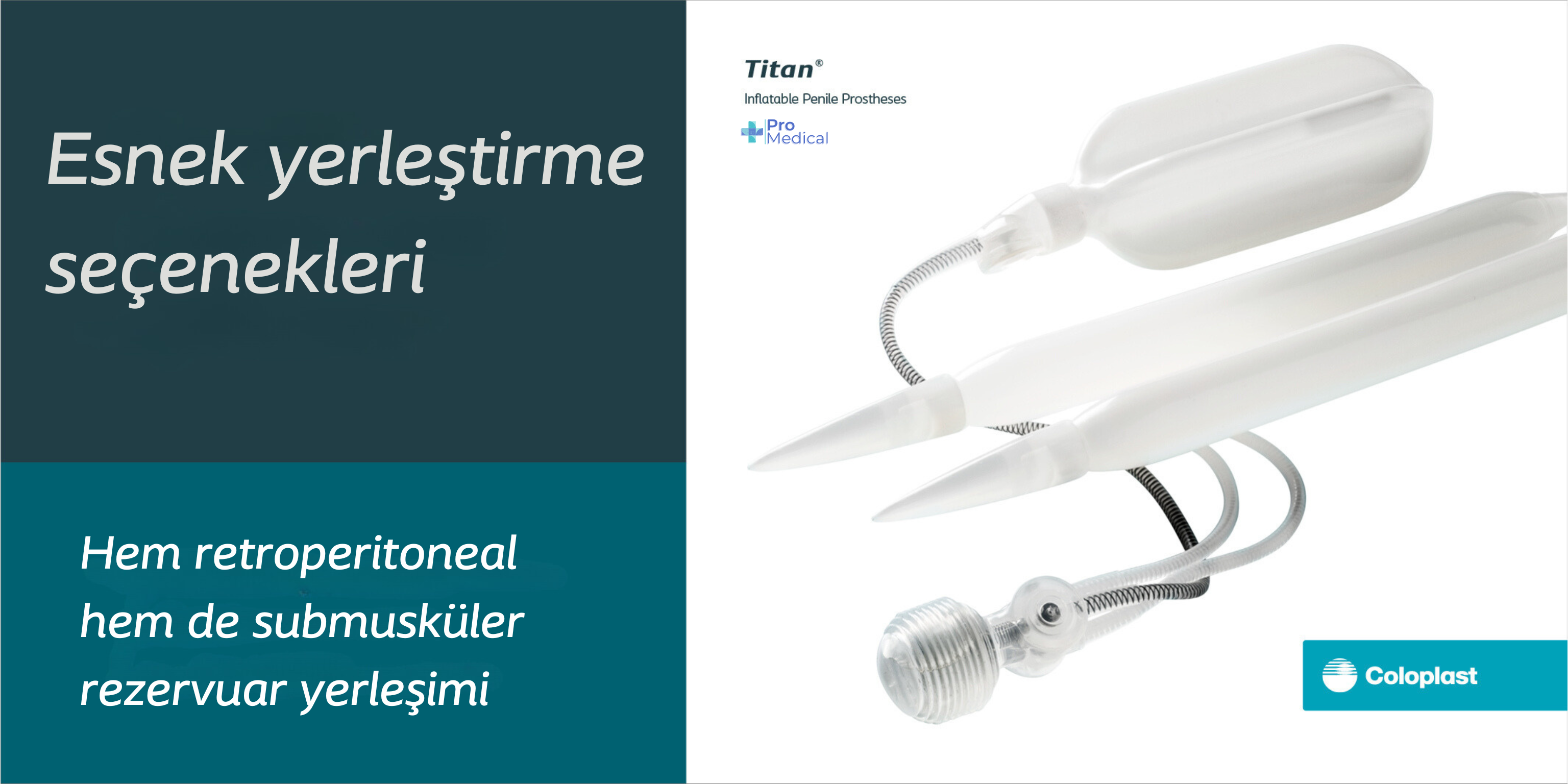 Titan rezervuar için esnek yerleştirme seçenekleri: hem retroperitoneal hem de submusküler yerleşim