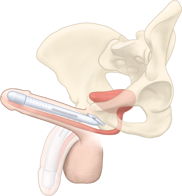 ZSI 100 FTM bükülebilir penil protezin anatomik yerleşimi: neofallus içine yerleştirilmiş tek gövdeli semi-rijit silikon implant